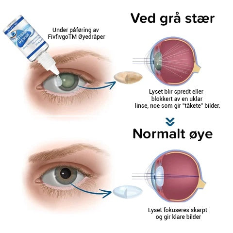 Nærsynthet Reversering øyedråper