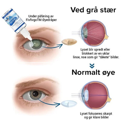 Nærsynthet Reversering øyedråper